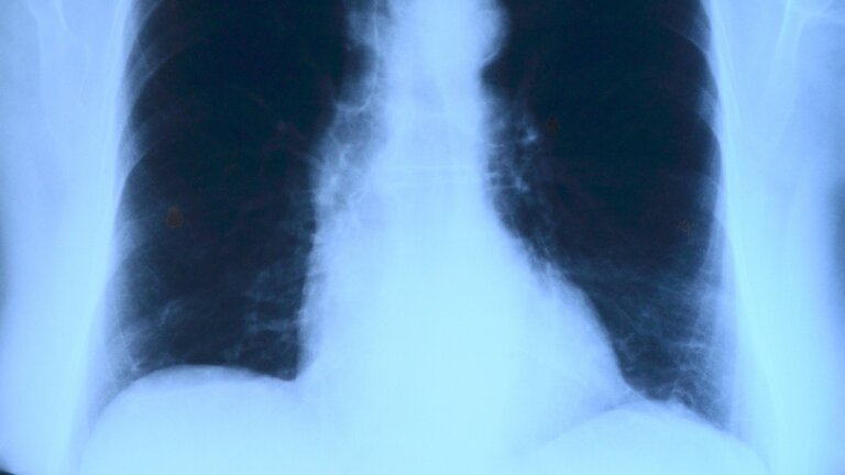 Röntgenaufnahme eines Oberkörpers, das insbesondere die Lunge zeigt. | © pixabay
