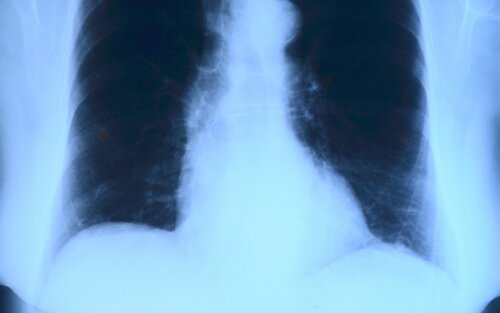 Röntgenaufnahme eines Oberkörpers | © pixabay