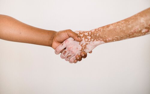 Nahaufnahme: Zwei Personen geben sich die Hand; eine Person hat Pigmentflecken | © Armin Rimoldi/pexels